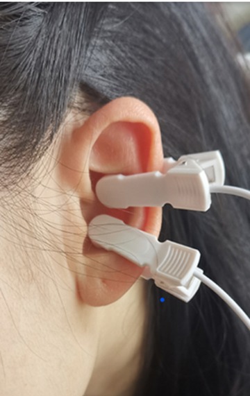Neuromodjulação vagal