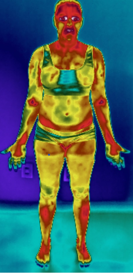 Exame de termografia médica
