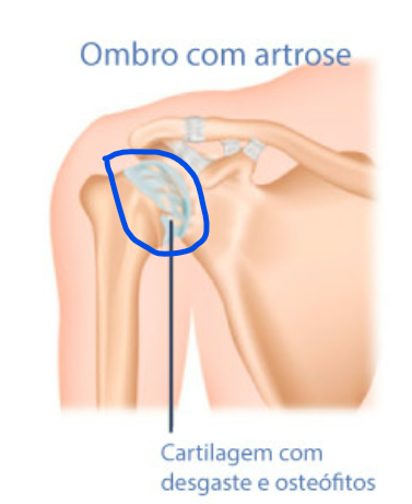 ombro com artrose