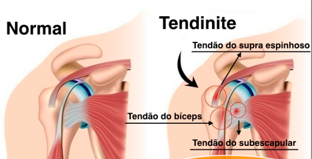 Tendinite no ombro